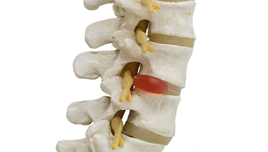 Herniated disc in spine before visiting Ohio chiropractor