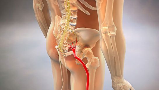 Sciatic nerve pain before chiropractic treatment from Ohio chiropractor